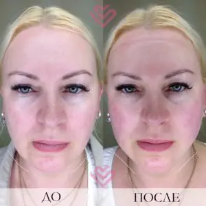 Smas до и после Киев