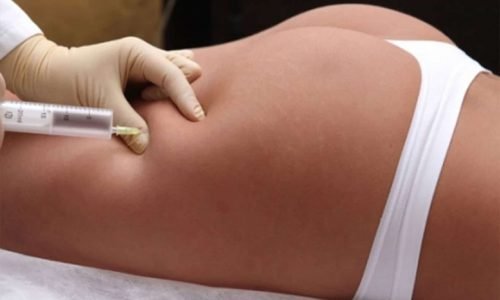 Что лучше липолитики или криолиполиз живота. Смотреть фото Что лучше липолитики или криолиполиз живота. Смотреть картинку Что лучше липолитики или криолиполиз живота. Картинка про Что лучше липолитики или криолиполиз живота. Фото Что лучше липолитики или криолиполиз живота
