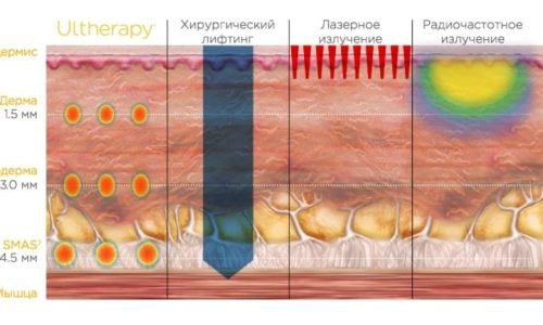 Snimok-ekrana-2019-06-27-v-22.17.19-750×432 смас лифтинг лица