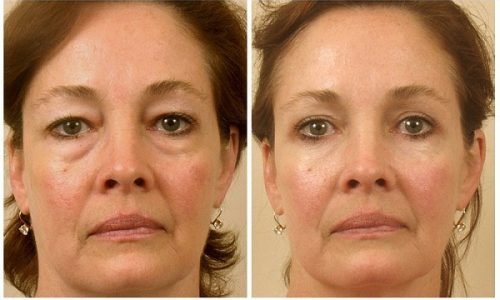 blefaroplastika-nizhnih-vek_14 blefaroplastika-nizhnih-vek_14