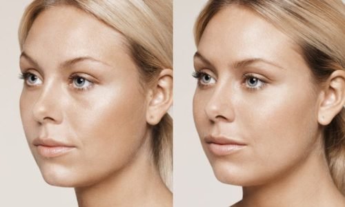 botox-fillers-resultat6-electa-min