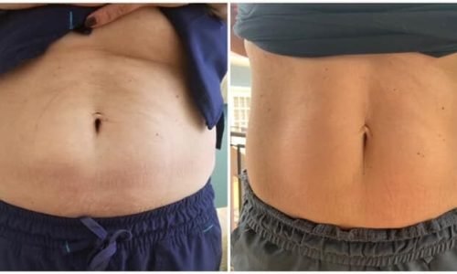 emsculpt-example emsculpt-example