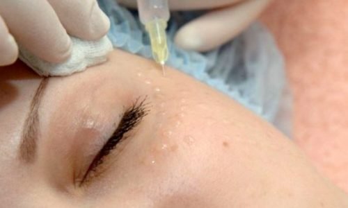 mesotherapy-around-eyes-5-768×437 mesotherapy-around-eyes-5-768x437