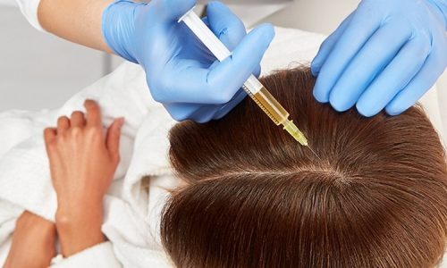 mesotherapy-hair