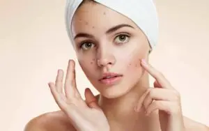 Read more about the article Избавиться от прыщей